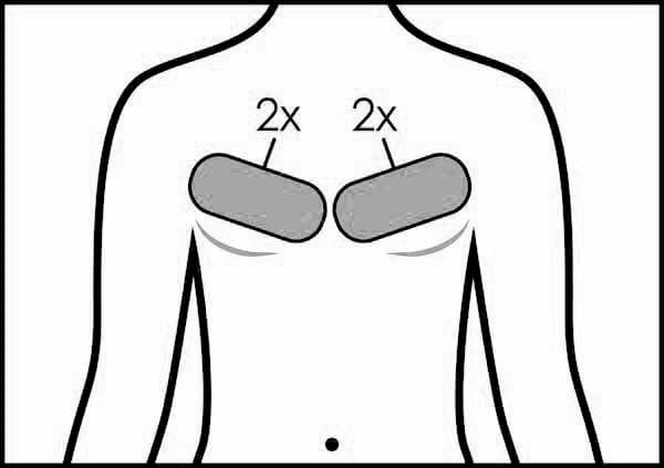 CoolSculpting Treatment Area: Men's Chest