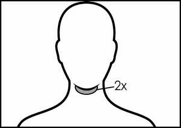 CoolSculpting Treatment Area: Chin