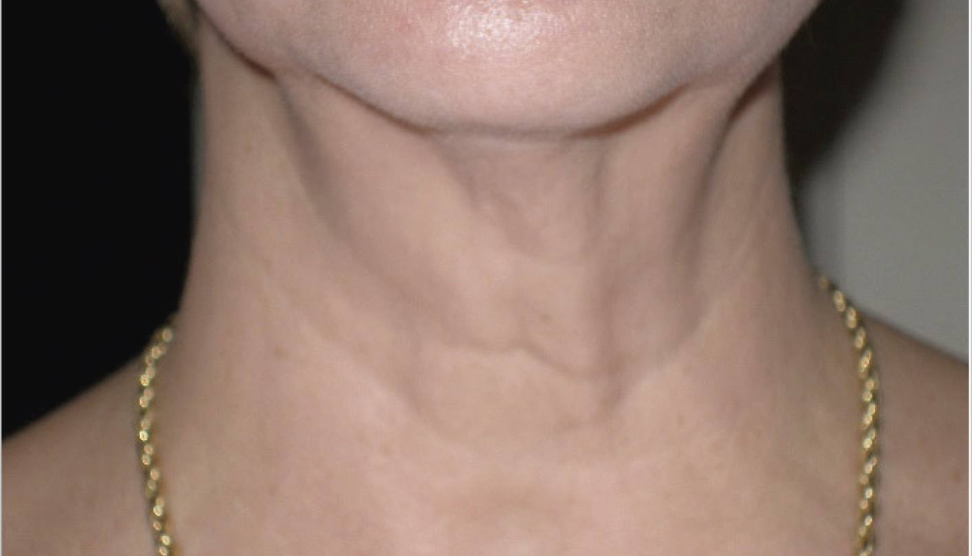 SkinTyte After
