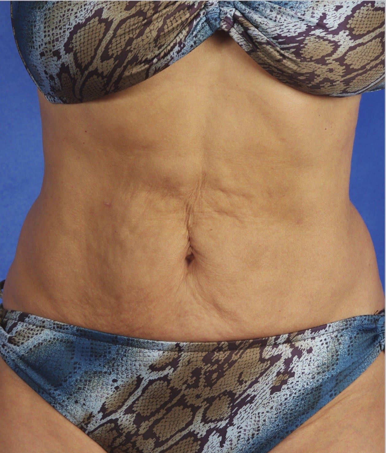 SkinTyte Before
