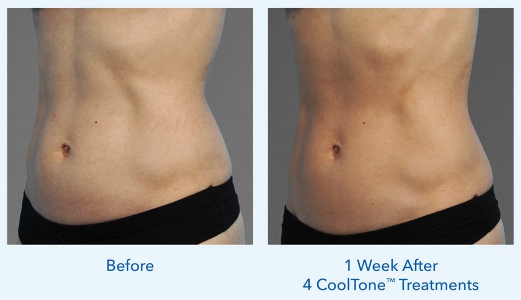 CoolTone before and immediately post-4 treatments