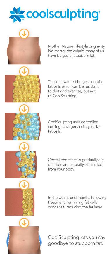 Coolsculpting process chart