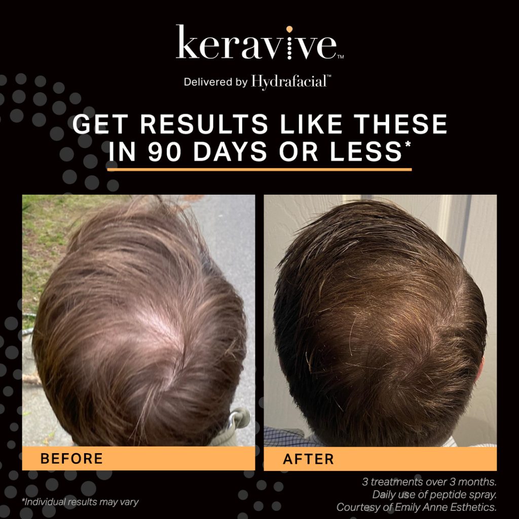 Keravive hair restoration - before and after 90 days