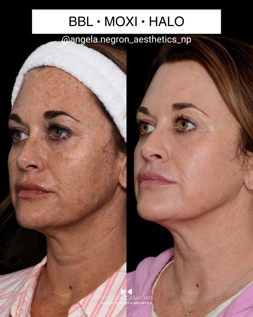 Left angle view of a real patient’s before and after laser skin resurfacing image