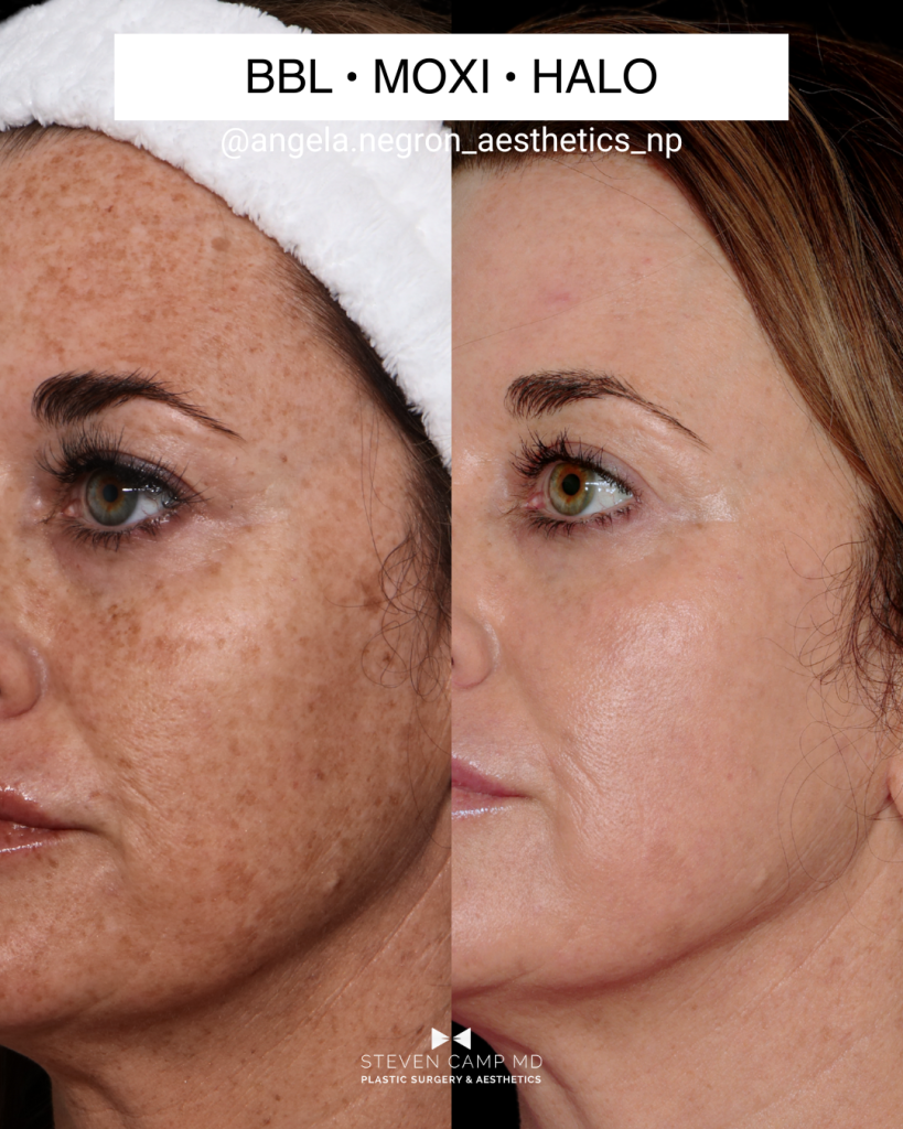 Close up of left angle view of a real patient’s before and after laser skin resurfacing image