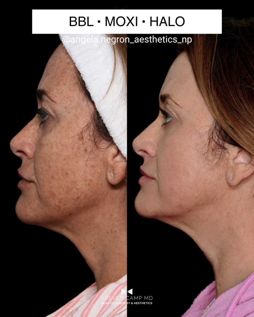 Lateral view of a real patient’s before and after laser skin resurfacing image