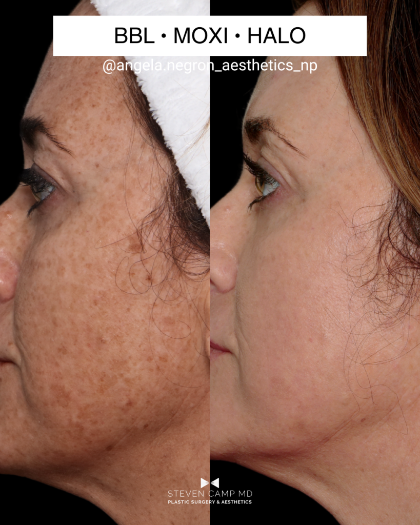 Close up lateral view of a real patient’s before and after laser skin resurfacing image