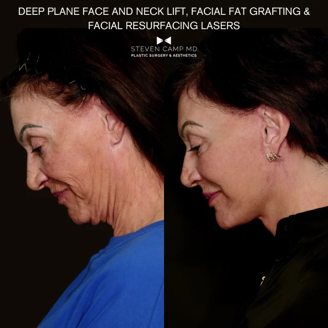 This is 69!

Our lovely patient is shown here 6 weeks after a revision deep plane facelift and neck lift with me. I think we effectively turned back the clock and improved upon her overall cheek and jawline contours, and dramatically improved the neck. Additionally, I was able to remove the visible scars around the ears from her previous lift. Her prior facelift was a traditional lift which relied on skin tension and not the deep plane. This traditional lift relapsed because the skin is not meant to bear tension over time. This caused her sagging skin and loose neck, and also created redness in the skin from it being thinned out. These broken blood vessels called telangiectasias occur when the skin is under excess tension. These are things we can’t fully correct in revision surgery alone. We will begin in office laser and light therapy with our Sciton BBL Heroic to get the reds out. Overall she feels and looks amazing, and in the next couple months we will perform office based Sciton lasers to clear the reds in the skin. 

Yet another reason I love the deep plane facelift. Looking forward to seeing the full glow up at 3-6 months once we have evened out the skin with our @sciton_inc lasers.
