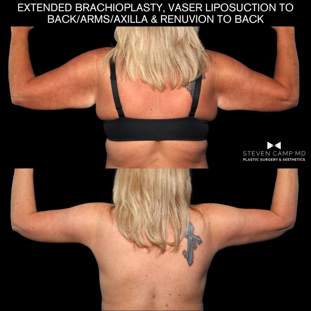 Warning ⚠️ 
Her arms may cause scheduling side effects…like wanting everything lifted, tightened, and contoured. Brachioplasty + Vaser Lipo + Renuvion magic at 45. 

Seriously, she looks amazing after this transformation. Photos 6 months post procedure. 

This is my style of plastic surgery- the version of you that just feels right. If you’re interested in this content please follow along and comment below. 👇🏻