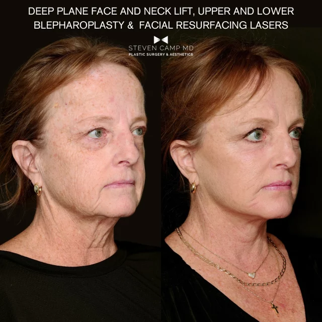 Natural Facelift Results Over 60 ✨
Look refreshed—not overdone.
A well-performed facelift can:
✅Lift the cheeks and midface
✅Smooth the neck
✅Reduce jowls
✅Define your jawline
✅Restore confidence

This case represents a 6 month follow up of a deep plane facelift and deep structural neck lift I performed for this patient. 

As much as possible we collected standardized photos with the same lighting and same camera in the same room. Admittedly she has make up in the after photos but otherwise everything is the same. 

Our mission is to provide real results for our patients, and also provide realistic expectations with our outcomes. There is no substitute for before and afters performed by your doctor in the procedure you are interested in. In my opinion this case is a natural and realistic result for a typical patient in their 60’s with a lot of Texas sun. 

The goal? A refreshed you—not a different you. 
#NaturalFacelift #FaceliftOver60 #AgeGracefully #FacialRejuvenation #RealResults #FaceliftJourney #over60andthriving