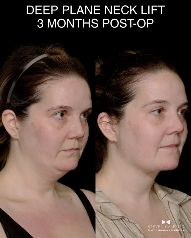 Snatched, sculpted, and serving side profile.

Because chin up was always the goal.

We so thank this patient for sharing her before and after because this helps other patients see what’s possible with surgery. 

Whenever you have questions about a surgical procedure you can always DM me or contact the office.  Here to take care of you!