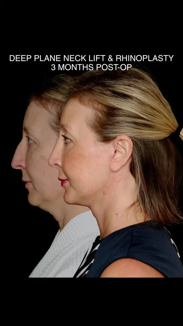 Glow Up. 

This sweet patient came to see me with goal of a refresh. She told me she wanted to look natural and still like herself but just refined. The goal was a smooth and subtle lift to the neck and a nicer profile. Here she is 6 months post surgery and she has an elegant neck and profile. 

For the interested and curious folks out there I have a summary of her procedures, (deep neck lift and rhinoplasty) below.

- Deep Plane Neck Lift: Repositions deep facial and neck tissues for a longer-lasting, more natural lift with improved contour through the jawline and neck.
- Rhinoplasty: Subtle refinement to enhance nasal proportions and bring balance to the patient’s overall profile.⁠ Smoothing out the hump, lifting the droopy tip, and straightening the nose. 
⁠
This strategic approach to facial rejuvenation addresses multiple areas in a single surgical plan, creating results that are both transformative and elegant.⁠
⁠
#FacialRejuvenation #DeepPlaneNeckLift #Rhinoplasty #FacialPlasticSurgery #ProfileBalancing