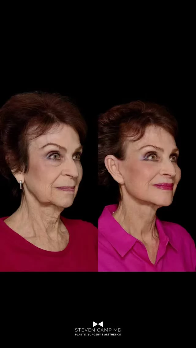 We are thrilled to introduce one of our favorite patients of all time 😉 an office staple, everyone meet Nelda! When our VIP patient says they’re ready to invest in themselves, we listen - we deliver. 

Nelda’s surgery will include:
- Deep plane facelift
- Deep neck lift
- Lower blepharoplasty
- Upper lip lift
- Fat transfer to her temples + mid cheeks
- Laser resurfacing to mouth +  under eyes
- Earlobe reduction

Stay tuned for more from Nelda’s surgical journey 💜
#deepplanefacelift #facialplasticsurgery #facelift #necklift #dfwplasticsurgeon