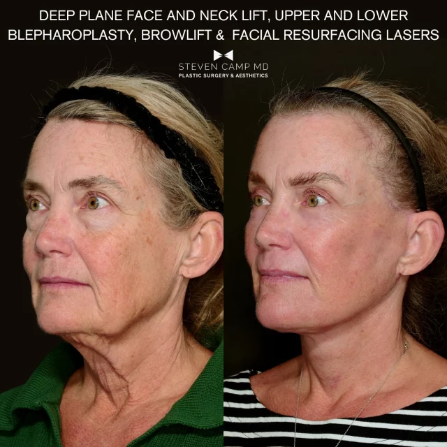 Just two months post-op: deep plane facelift, neck lift, upper + lower bleph, and full-face Sciton laser.

No filters. No face app. Just skill, science, and a little surgical magic. Face card never denied. 

✔️ Deep plane lift to bring the structure back
✔️ Neck lift for the jawline you forgot existed
✔️ Blephs so she can skip the under-eye concealer
✔️ Laser so smooth she might slide off the pillow

This is not your cousin’s filler appointment.
It’s full-face rejuvenation, tailored, balanced, and designed to age gracefully (or, let’s be honest, kind of perfectly.)

She looks rested, refreshed, and booked through the holidays. Zoom in responsibly. 

All kidding aside, we thank this patient for sharing her before and afters because it takes true kindness and openness to help future patients. It’s a journey to go through plastic surgery and share with others, especially facial procedures so we appreciate her showing her early progress. 

She will continue to see refinement over the coming year.

To book your consultation call the office at 817-228-4315

#DeepPlaneFacelift #Blepharoplasty #NeckLift #ScitonLaser #BeforeAndAfter #ModernPlasticSurgery #fortworthfacelift