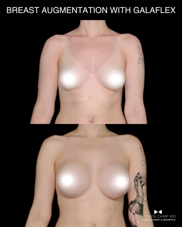 Proof that sometimes… a little volume makes a major difference 😉

This patient underwent a breast augmentation with Galaflex Internal Bra placement and was kind enough to share her 11 month after photos. 

Our goal is for patients to get back to normal life as soon as possible, feel confident and be their best each day. 

Breast augmentation surgery is helpful to:
• Restore breast size and shape after pregnancy or breast feeding 
• Embrace your curves and femininity 
• Enhance your symmetry and body contours 
• Improve the fit of your clothes, swimsuits and workout gear
• increase your confidence and boost body image

We look forward to taking care of you 💯