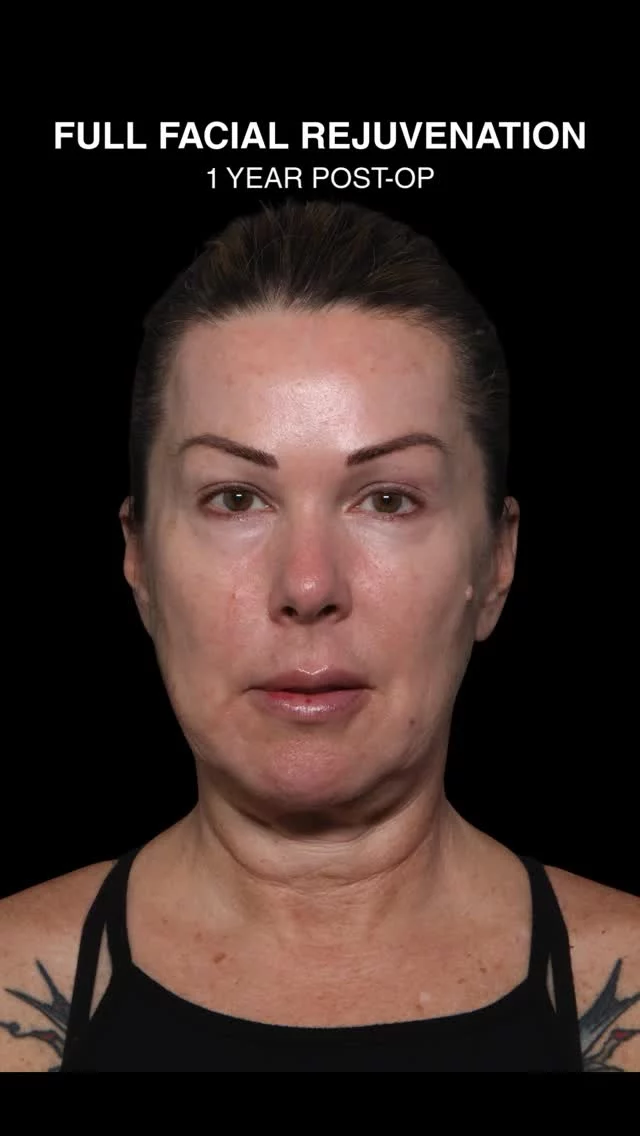 ✨ One year post-op ✨
Deep Plane Facelift • Neck Lift • Upper & Lower Blepharoplasty • Lip Lift • Buccal Fat Pad Removal

I can’t get enough of results like these. Why, because they are what I always strive for, natural, balanced, and lasting. Our patient is one year out from a combination of procedures: a deep plane facelift to reposition and lift the deeper layers, a neck lift for definition, upper and lower eyelid surgery to open and brighten the eyes, a lip lift for youthful proportion, and buccal fat pad removal for sculpted cheeks. To top it all off, deep laser resurfacing intra-operatively to provide that amazing skin glow. 

With advanced continued training in deep plane techniques  and by spending time with leading worldwide and US experts, I have been able to provide my patients with an approach that creates long-lasting natural results. 

Additionally, in our practice, we believe great surgery and great skin go hand in hand. That’s why every surgical journey includes a customized SkinCeuticals medical-grade skincare protocol. Healthy, glowing skin is the perfect complement to surgical artistry.

And here’s the part I wish more people knew: you don’t have to wait until you’re “older” for facial rejuvenation. Starting earlier means you not only look refreshed sooner, but you also get to enjoy your results for longer. 💫

📍 Natural artistry. Surgical precision. Exceptional Lasers. Medical-grade skincare.